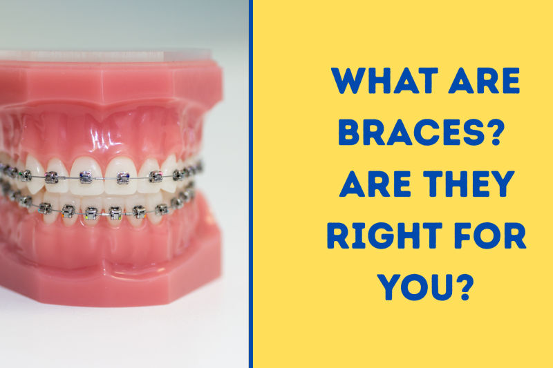 What Are BracesA Complete Guide to Orthodontic Braces