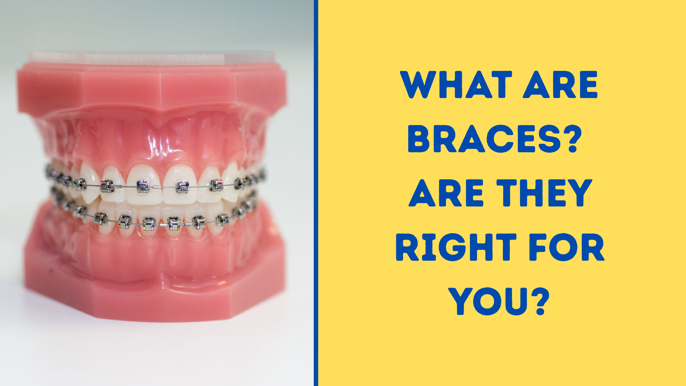 What Are BracesA Complete Guide to Orthodontic Braces